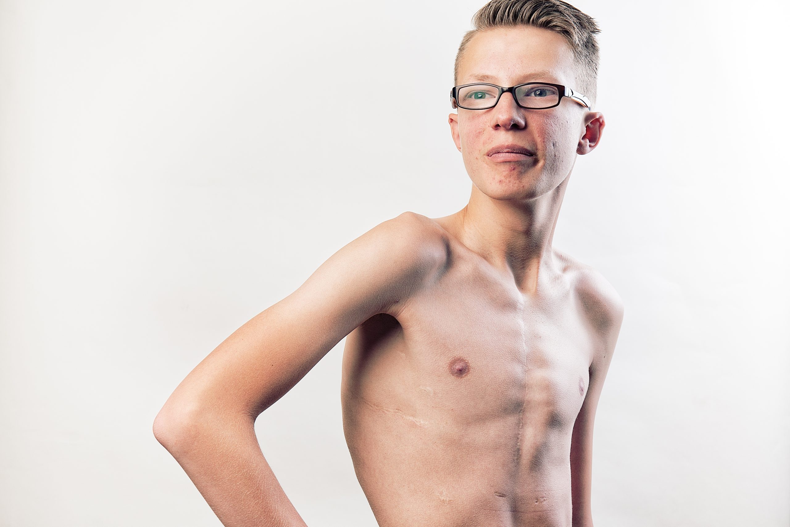 Jongen met 22q11 poseert voor een fotoshoot van Stichting Steun 22Q11, te zien is een litteken op zijn borst